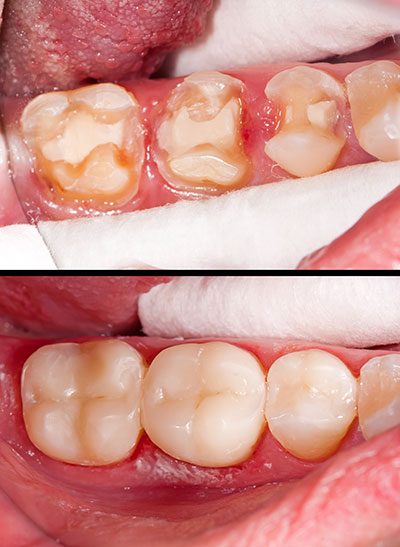 Albee Dental Care | Dentures, Periodontal Treatment and Invisalign reg 