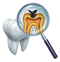 Albee Dental Care | Preventative Program, Dental Sealants and Emergency Treatment