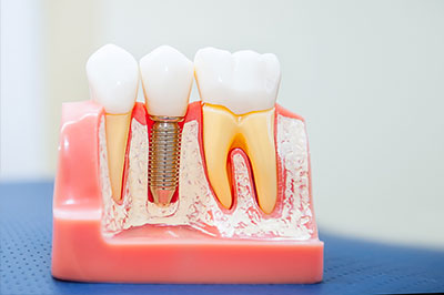Albee Dental Care | Oral Exams, Extractions and Veneers
