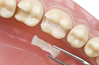 Albee Dental Care | Preventative Program, Root Canals and Invisalign reg 