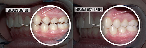Albee Dental Care | Sleep Apnea, Extractions and Snoring Appliances