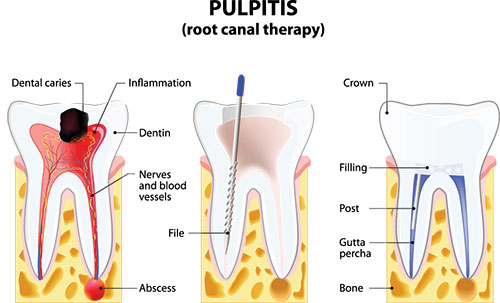 Albee Dental Care | Night Guards, TMJ Disorders and Dental Cleanings