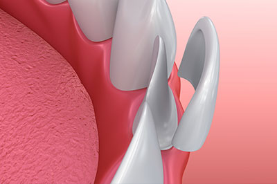 Albee Dental Care | Implant Dentistry, Night Guards and Snoring Appliances