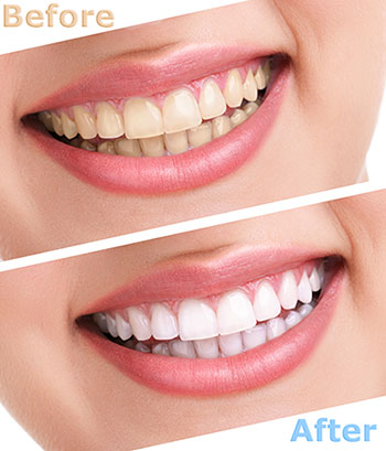 Albee Dental Care | Dental Sealants, TMJ Disorders and Extractions
