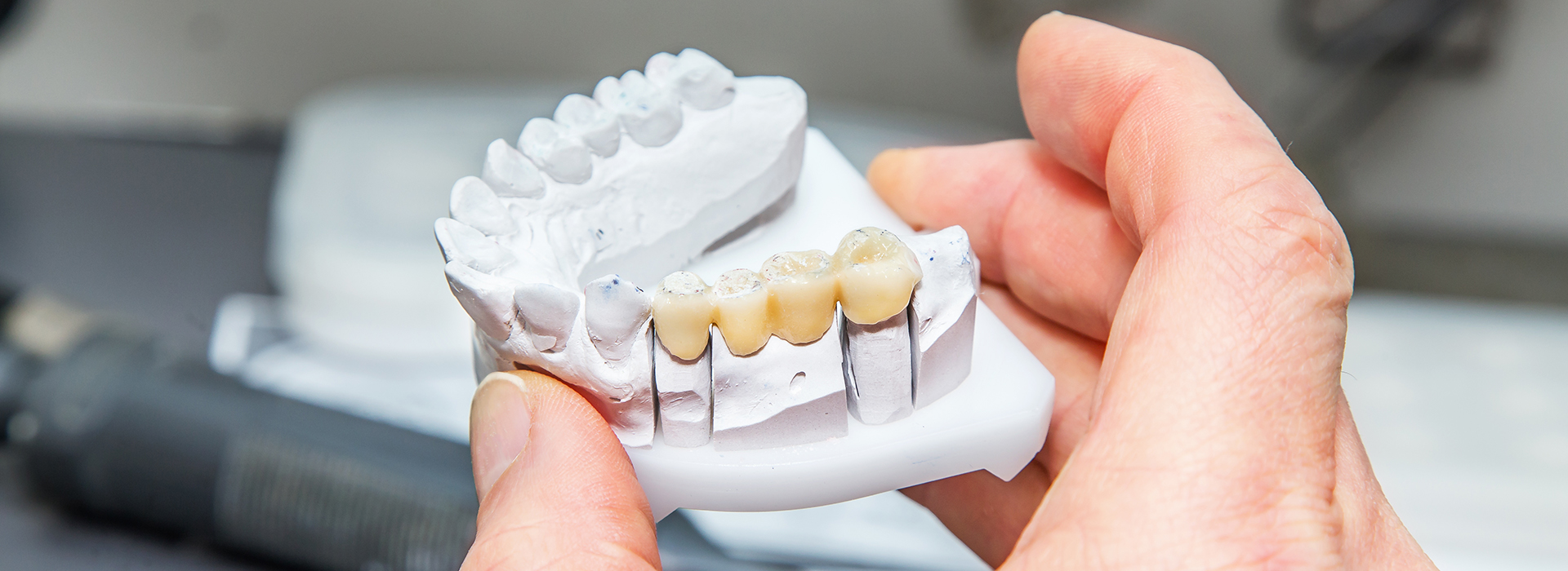 Albee Dental Care | Root Canals, Preventative Program and Night Guards